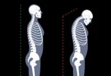 Kifoz Nedir, Egzersizleri Nelerdir? Kifoz Belirtileri